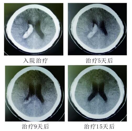 腦出血你不得不引起重視的疾?。。?！