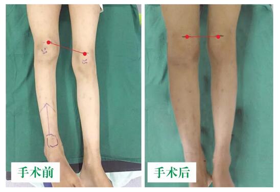 女孩墜梯右腿縮短5cm，幸得醫(yī)生及時診治恢復(fù)正常腿型