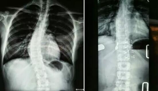 好好的脊柱怎么說彎就彎了？你竟然都沒發(fā)現(xiàn)……
