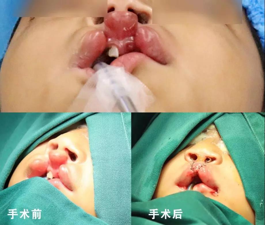唇腭裂盡早治療消除孩子自卑心理，快樂成長！