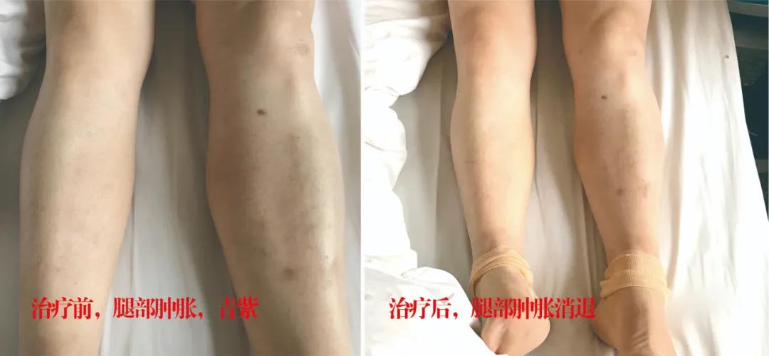 下肢靜脈血栓多年頑疾反復(fù)腫痛——疾病不容等待，早治療，早健康！