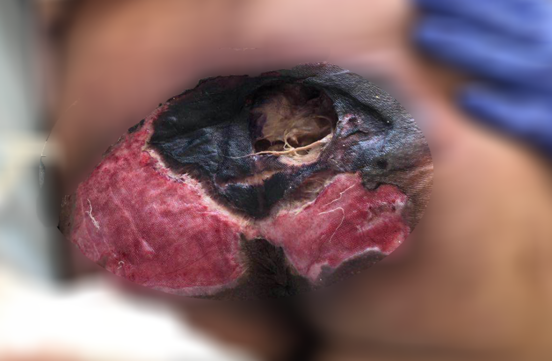 癱瘓3年的女患者臀部居然變成這樣?！