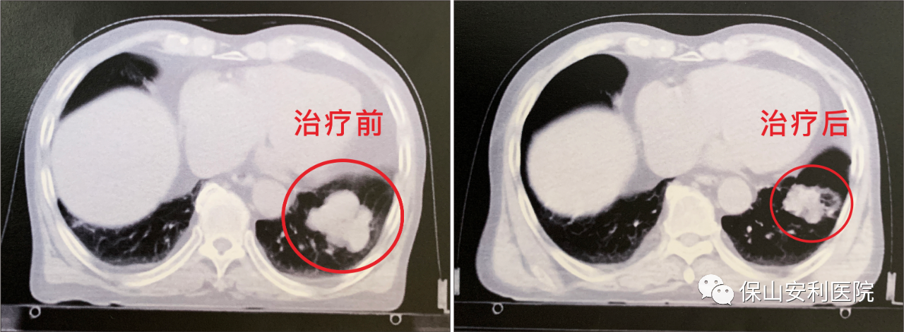 不做手術(shù)，早期肺癌也能根治！