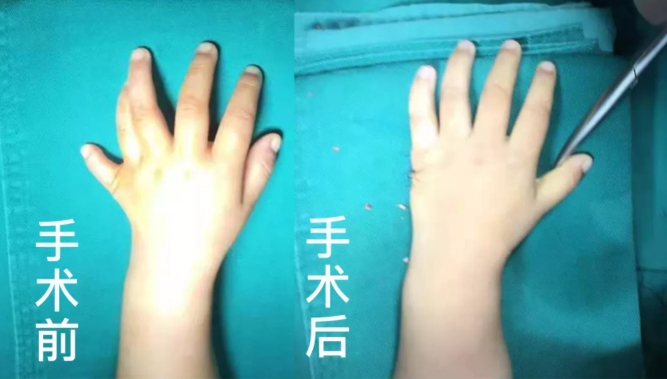 【保山安利醫(yī)院】2歲小兒手、足多指（趾）成功修復(fù)(矯正）！