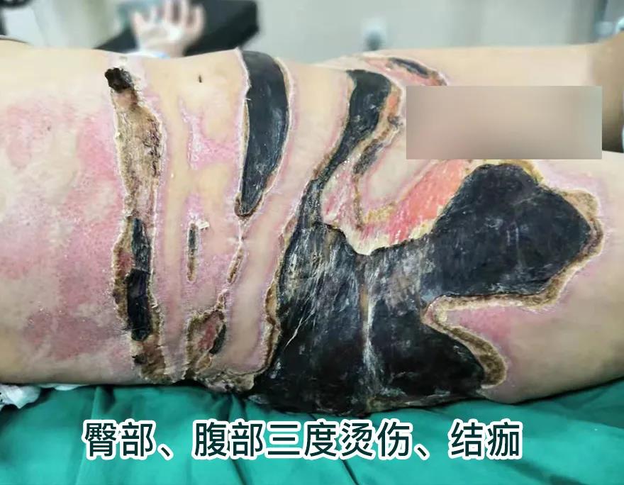 【保山安利醫(yī)院】80歲老人不慎燒傷，導(dǎo)致腹部、右側(cè)臀部大面積創(chuàng)傷，經(jīng)植皮治療創(chuàng)面逐漸愈合