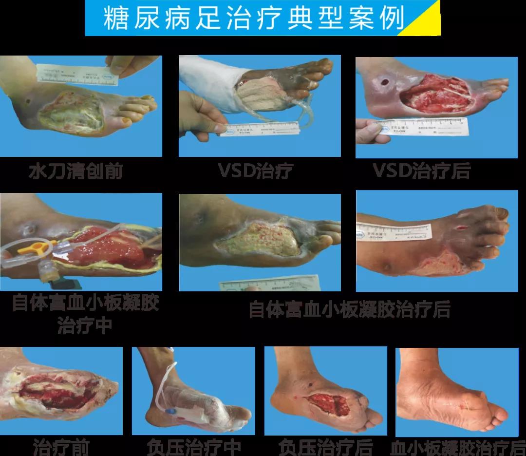 截肢、失明，甚至……，我們要做的是將糖尿病并發(fā)癥遏制在搖籃里！