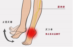 【保山安利醫(yī)院—健康科普】什么是足下垂！你了解嗎？
