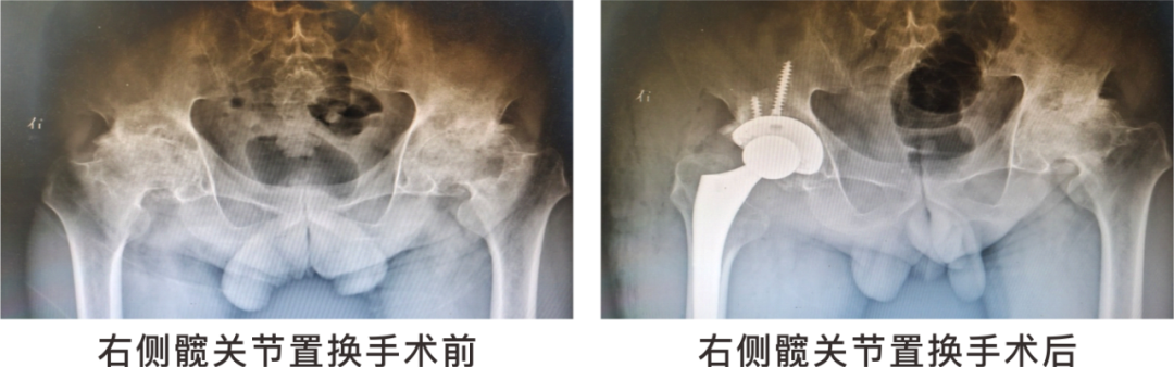 【保山安利醫(yī)院】長期飲酒導(dǎo)致雙側(cè)股骨頭壞死，髖關(guān)節(jié)置換后重獲運(yùn)動(dòng)功能！