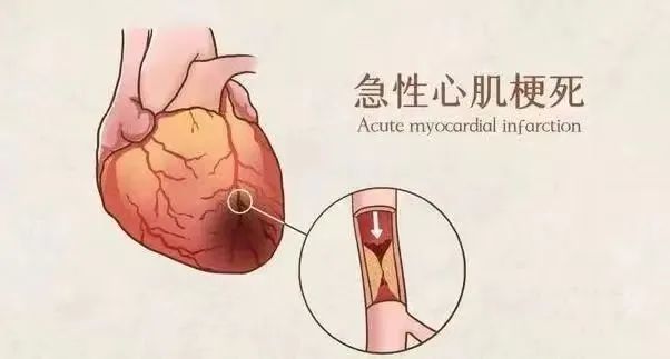 【保山安利醫(yī)院】11月20日“心梗救治日” 時間就是心肌，時間就是生命！